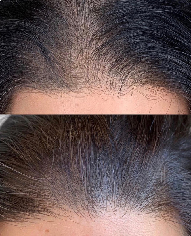 تصویر هیر فیلر دکتر سی وای جی اصل کره | تقویت مو و پرپشتی با نتیجه سریع و ماندگار در دسته هیرفیلر